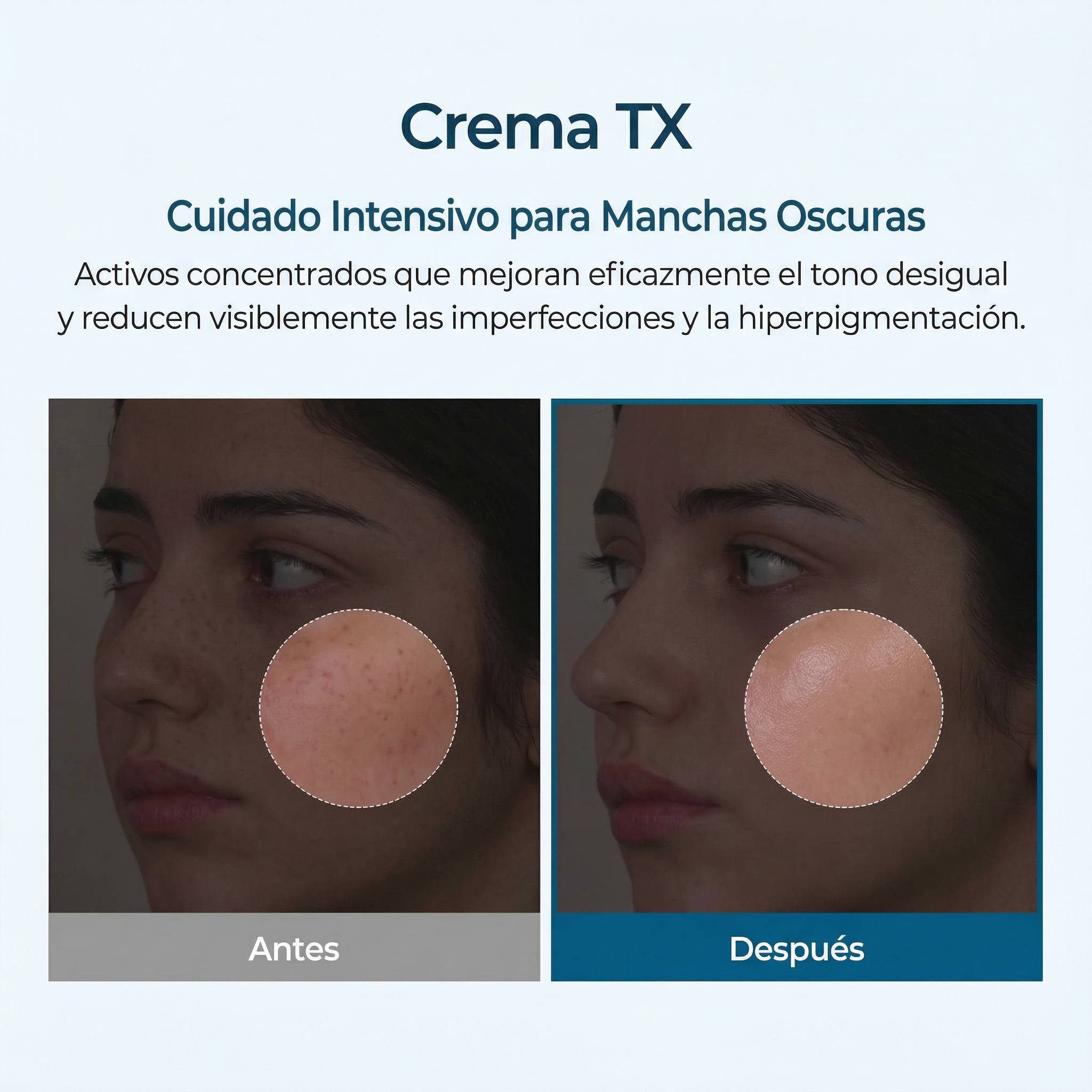 Crema despigmentante